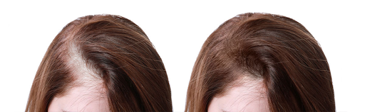 Как остановить выпадение волос? Делаем уколы мезотерапии