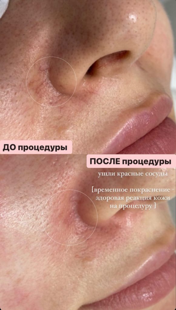 Удаление дефектов кожи на лице